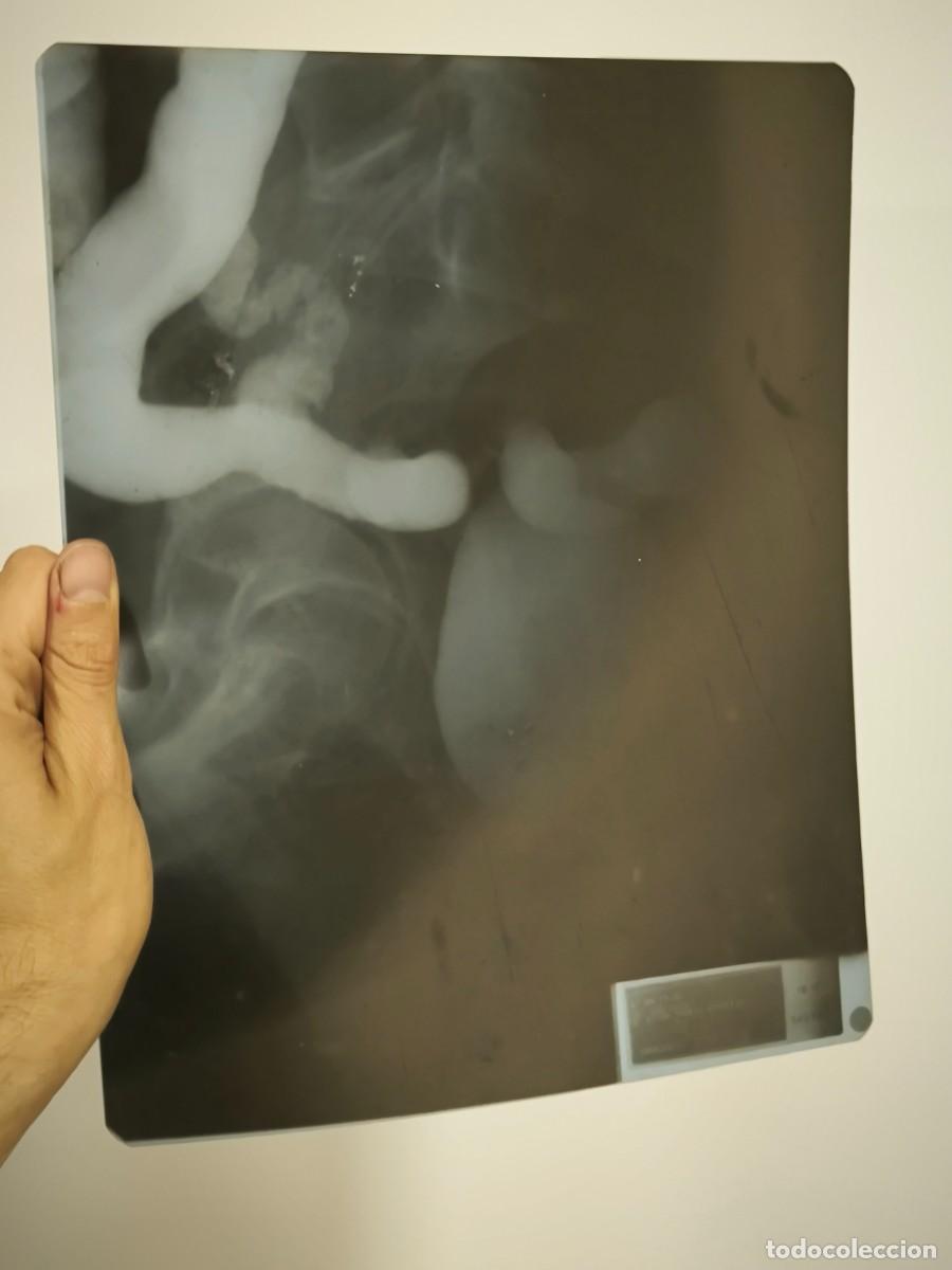 Antiquit&eacute;s: Radiograf&iacute;a M&eacute;dica Original 30x24 Cm &ndash; Placa Diagn&oacute;stica Vintage Para Decoraci&oacute;n Industrial