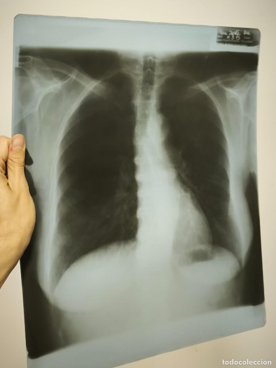 Antiquit&eacute;s: Radiograf&iacute;a M&eacute;dica De T&oacute;rax Original &ndash; Placa Cl&iacute;nica Real Para Coleccionismo O Decoraci&oacute;n