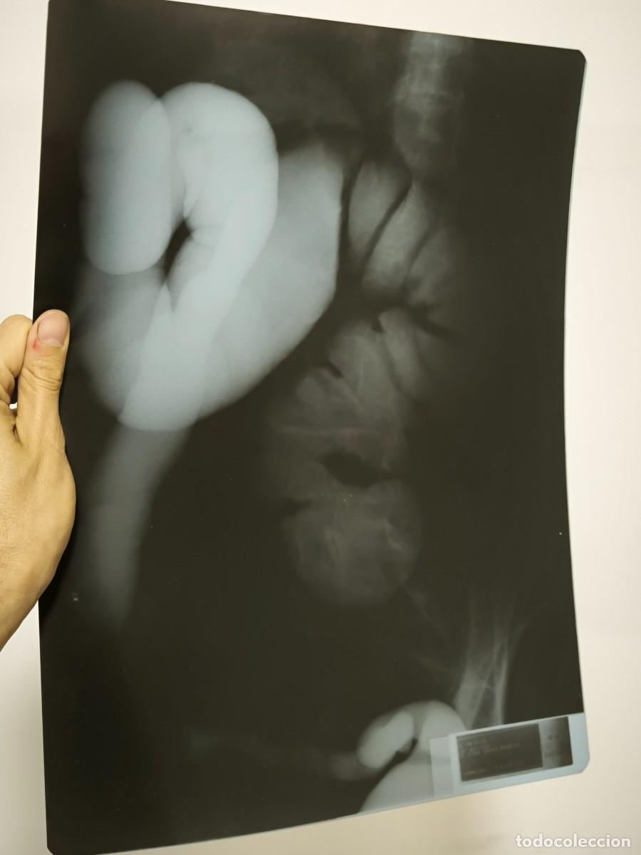 Antig&uuml;edades: Radiograf&iacute;a M&eacute;dica De Abdomen &ndash; V&iacute;sceras Internas Original Placa Cl&iacute;nica Aut&eacute;ntica