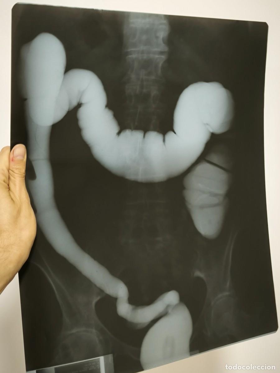 Antiguidades: Radiograf&iacute;a M&eacute;dica De Abdomen Con Contraste &ndash; Imagen Cl&iacute;nica De V&iacute;sceras Intestinales
