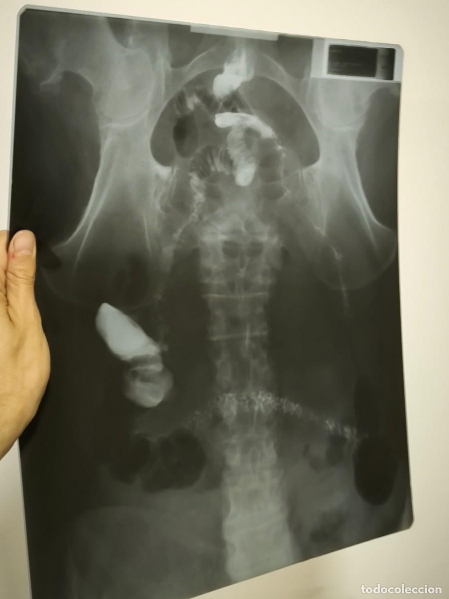 Antig&uuml;edades: Radiograf&iacute;a M&eacute;dica De Abdomen Completo &ndash; Placa Cl&iacute;nica Original De V&iacute;sceras Internas