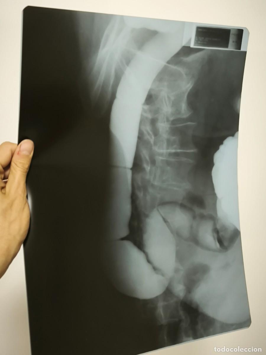 Antiquit&eacute;s: Radiograf&iacute;a M&eacute;dica Lateral De Abdomen Con Contraste &ndash; Placa Cl&iacute;nica De V&iacute;sceras Internas