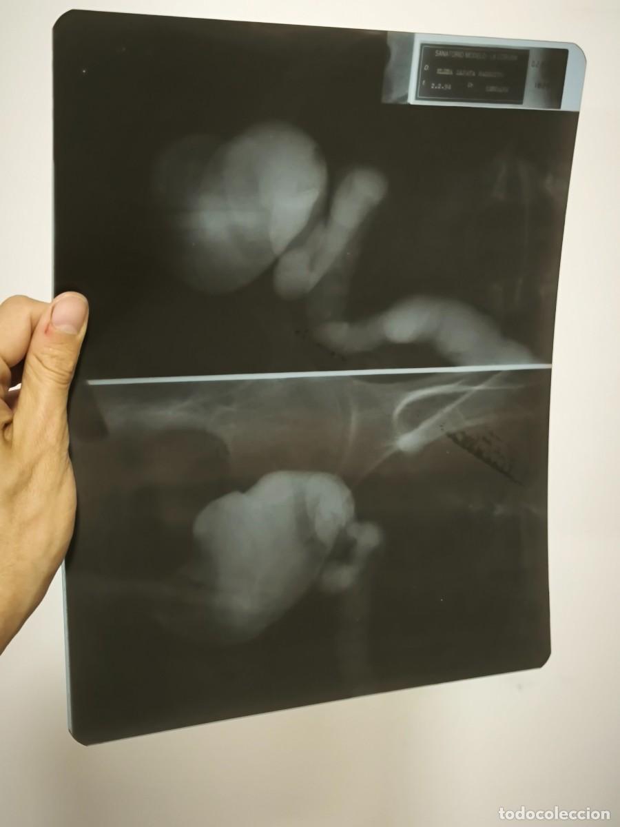 Antig&uuml;edades: Radiograf&iacute;a M&eacute;dica De Abdomen Con Contraste &ndash; Placa Cl&iacute;nica Original Doble Vista