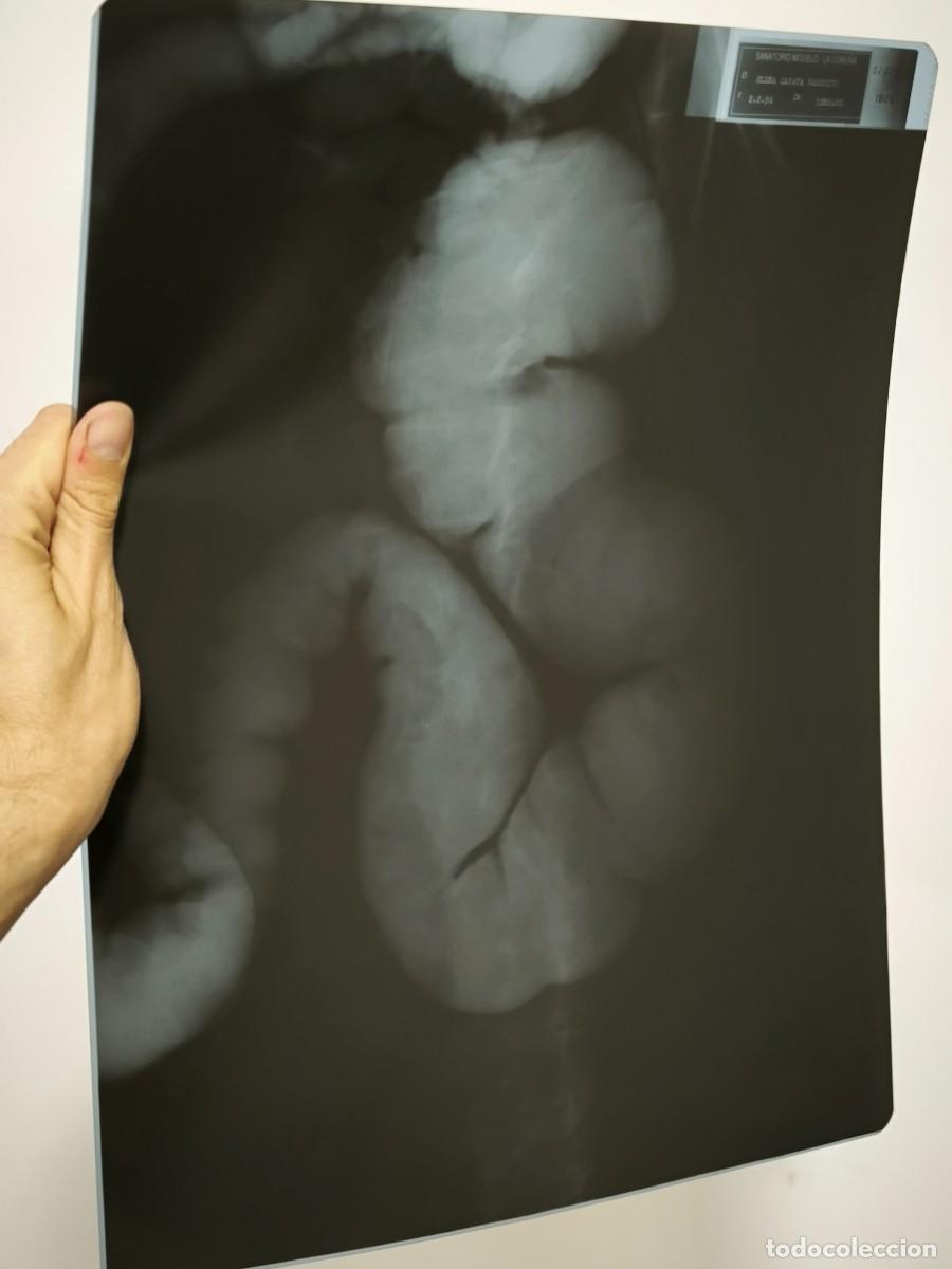 Antiques: Radiograf&iacute;a M&eacute;dica De Abdomen Con Contraste &ndash; Placa Original De V&iacute;sceras En Alto Detalle