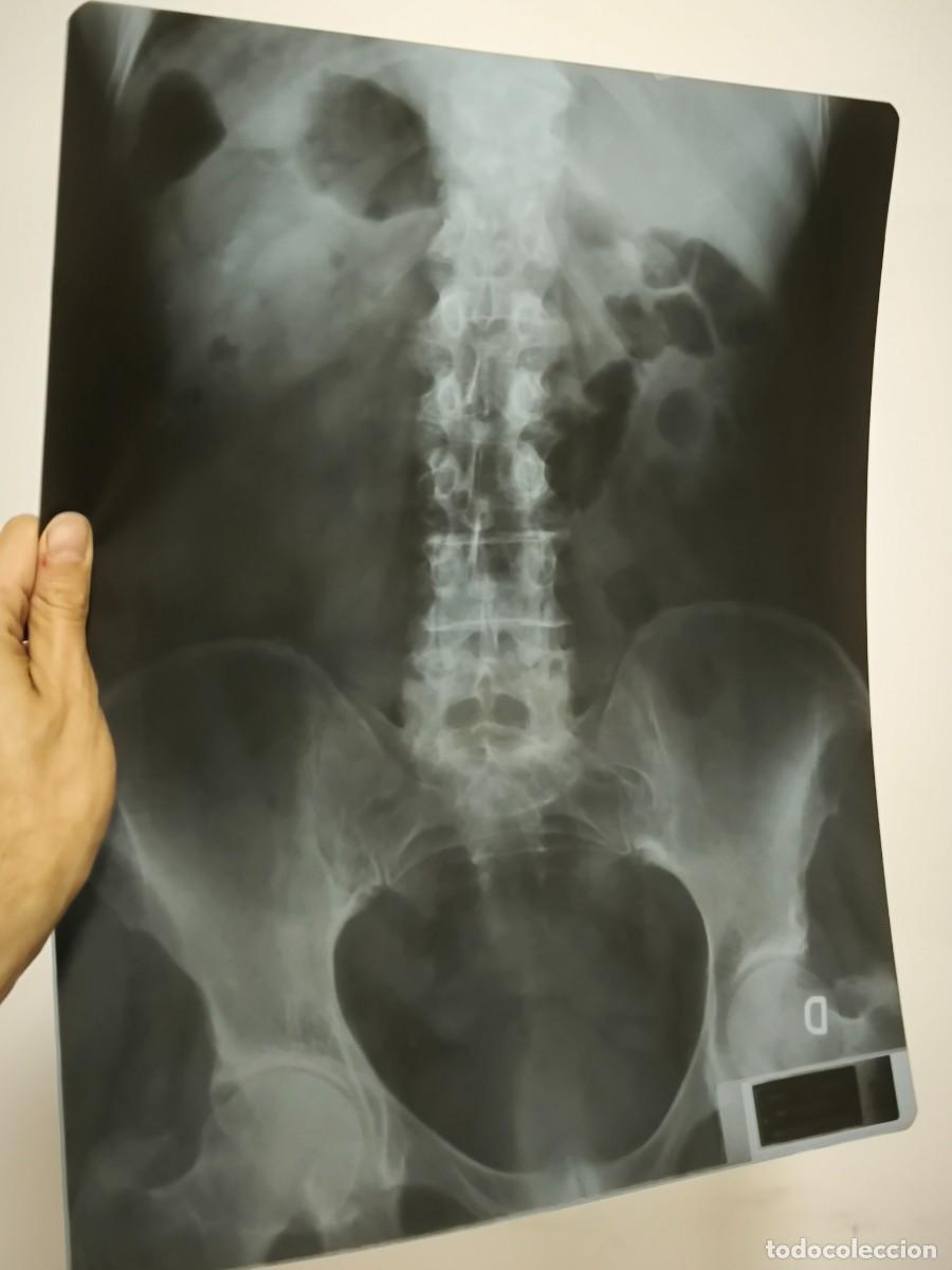 Oggetti Antichi: Radiograf&iacute;a M&eacute;dica De Abdomen &ndash; Placa Original Con Vista &Oacute;sea Y Gas Intestinal