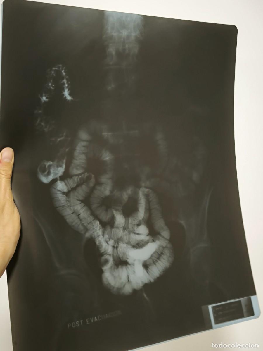 Antiquit&auml;ten: Radiograf&iacute;a M&eacute;dica Antigua Sistema Digestivo 43x36 Cm &ndash; Placa Original Vintage