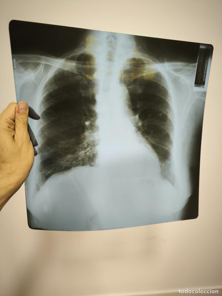 Antiques: Radiograf&iacute;a M&eacute;dica Antigua T&oacute;rax Pulmones 36x36 Cm &ndash; Placa Original Vintage