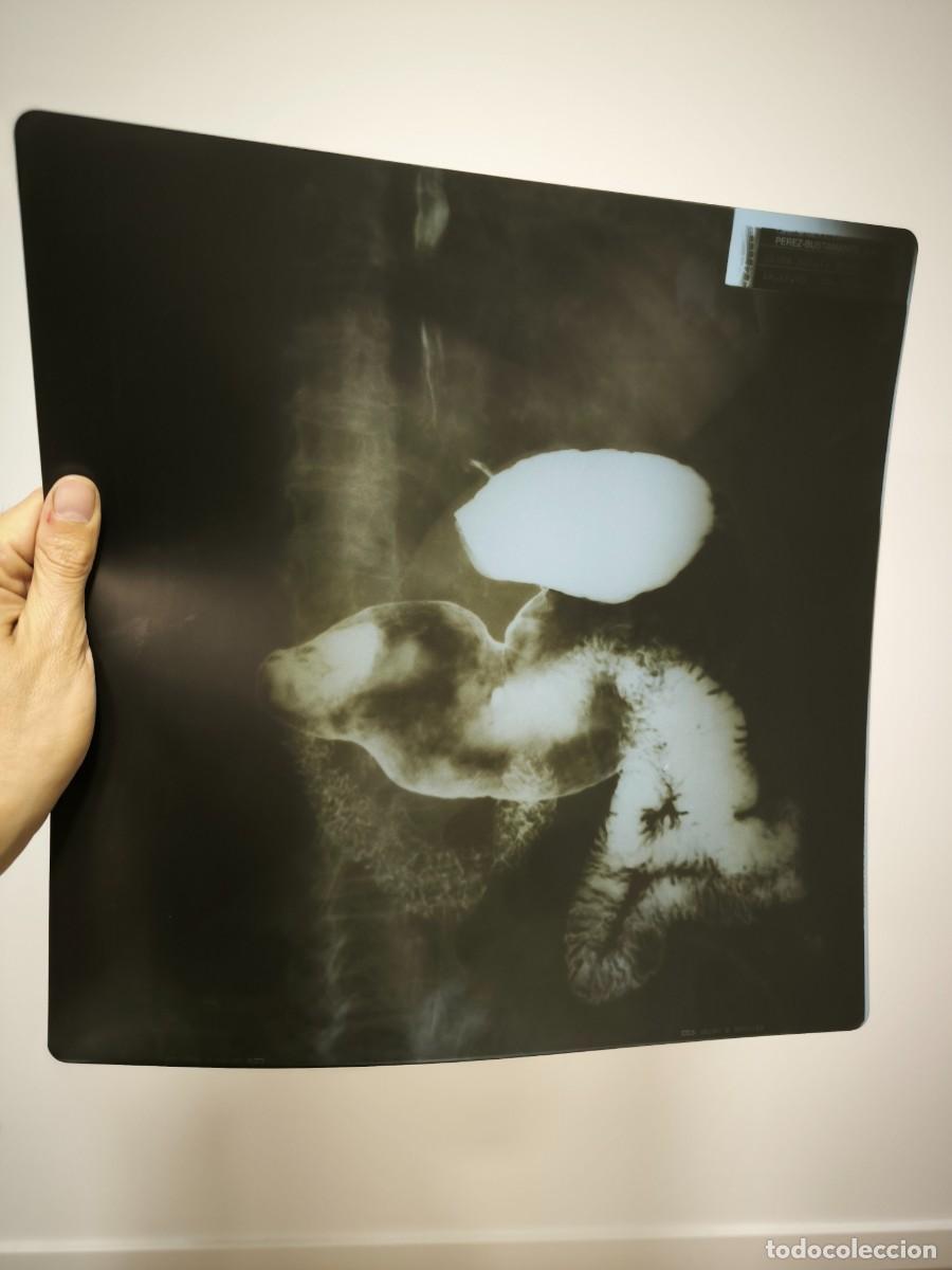 Antiques: Radiograf&iacute;a M&eacute;dica Original Vintage 36x36 Cms &ndash; Placa Diagn&oacute;stica Aut&eacute;ntica De Archivo Cl&iacute;nico