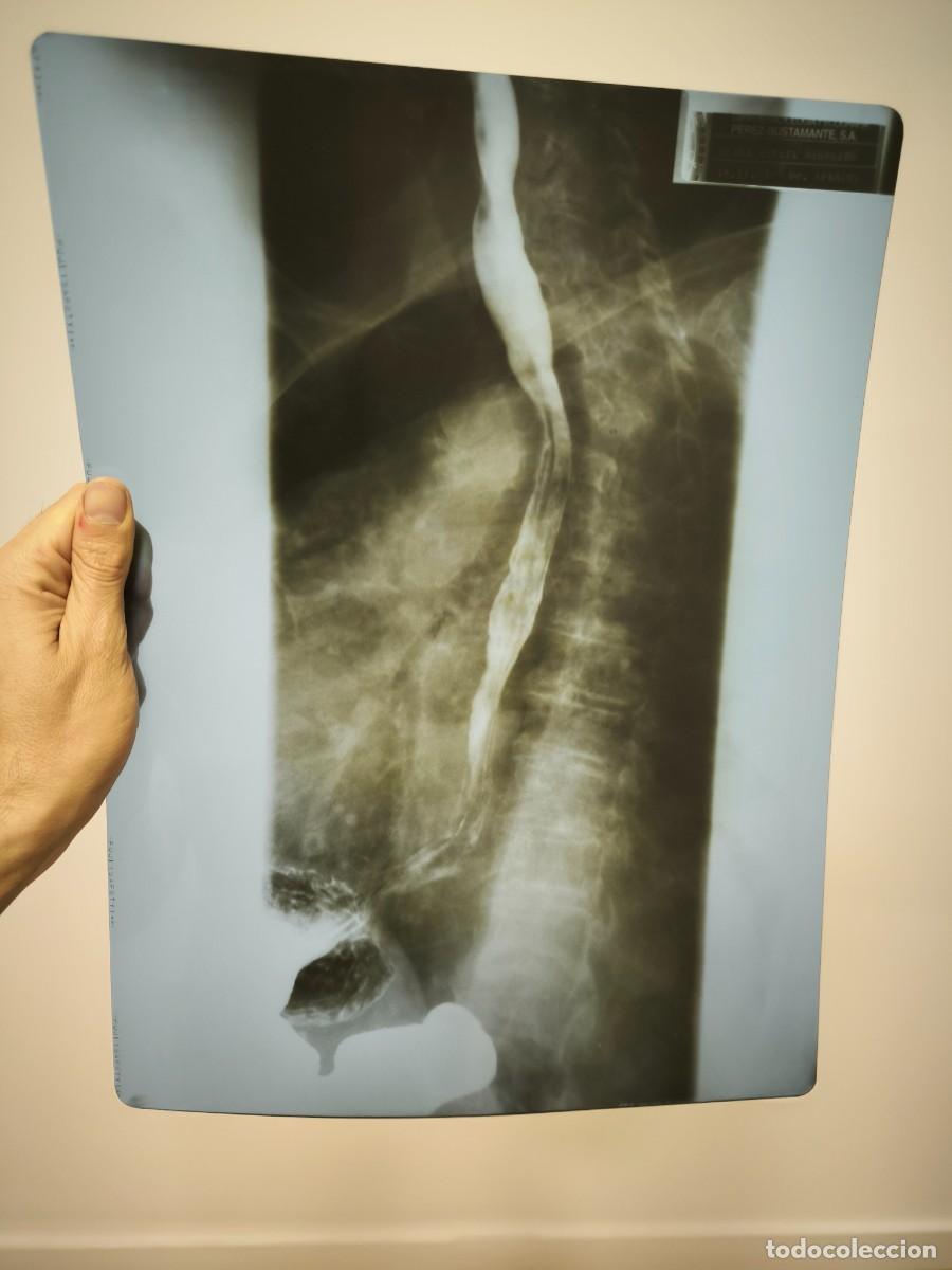 Antiquit&eacute;s: Radiograf&iacute;a M&eacute;dica Original Vintage 40x30 Cms &ndash; Placa Cl&iacute;nica Aut&eacute;ntica Para Decoraci&oacute;n Y Colecci&oacute;n