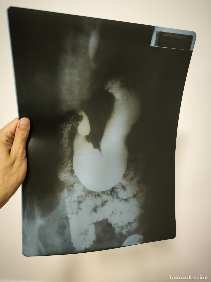 Antiques: Radiograf&iacute;a M&eacute;dica Vintage 40x30 Cms &ndash; Placa Diagn&oacute;stica Antigua Decoraci&oacute;n Retro