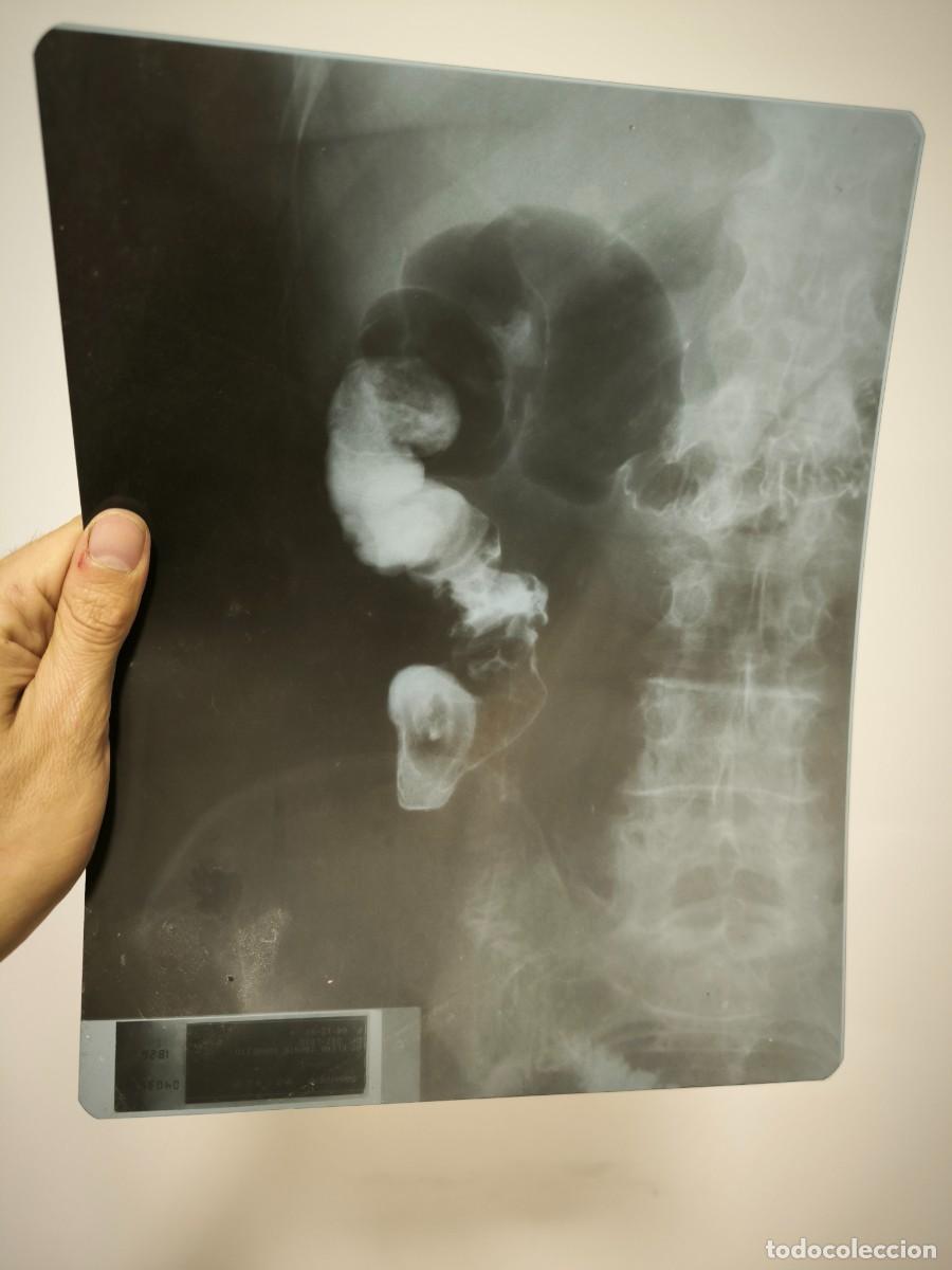 Antig&uuml;edades: Antigua Radiograf&iacute;a M&eacute;dica Original &ndash; Placa Diagn&oacute;stica Vintage 30x24 Cms