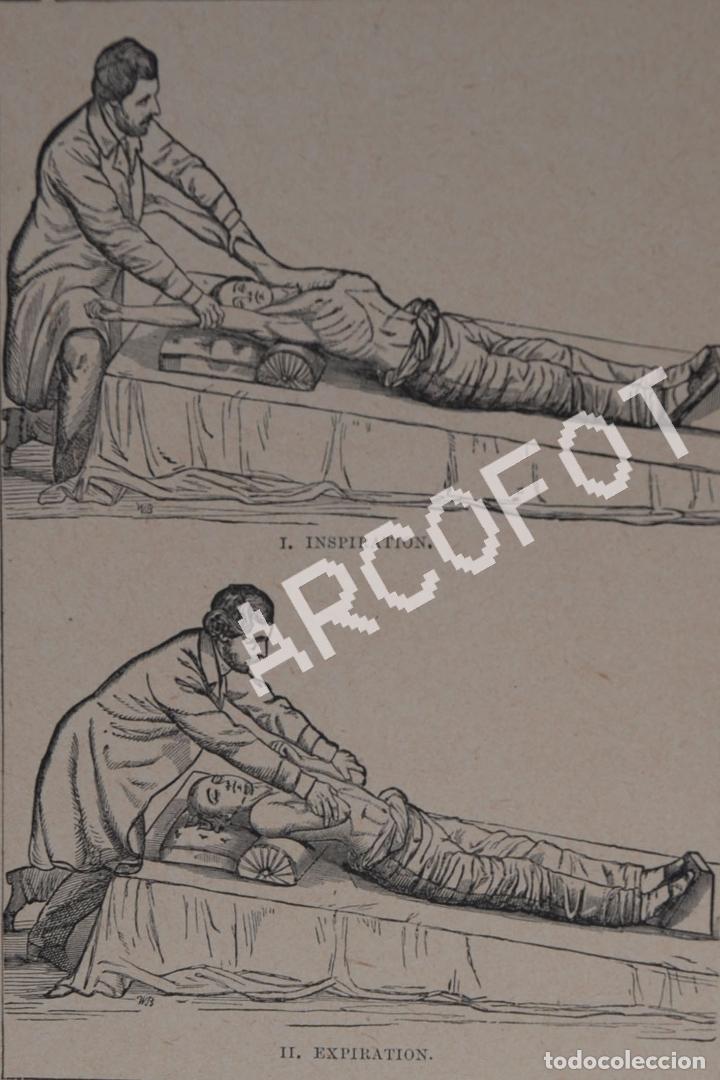 Art: Antiguo grabado (c. 1909) - DR. H. R. SILVESTER'S METHOD OF INDUCING RESPIRATION