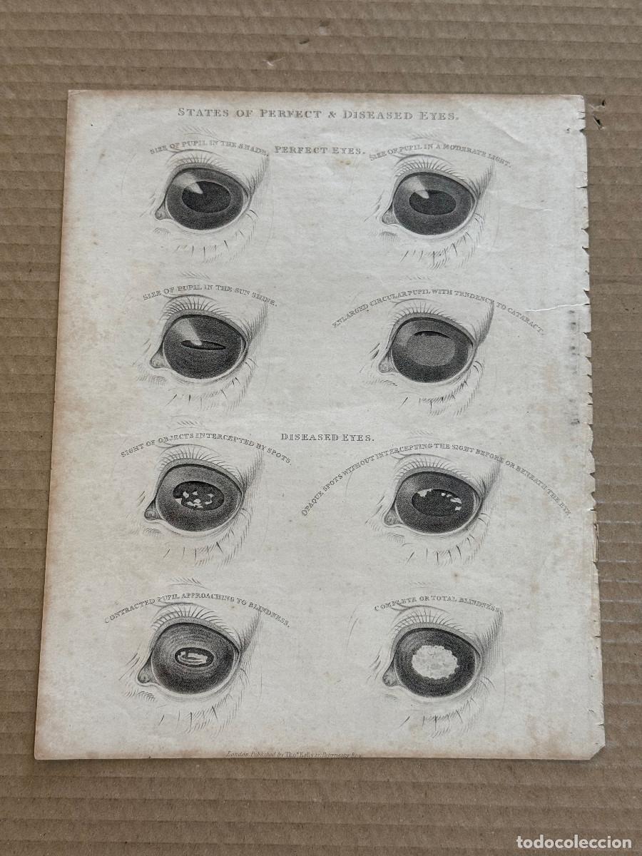 Arte: GRABADO SIGLO XIX / OFTALMOLOGIA / STATES OF PERFECT & DISEASES EYES / c.27 x 21 cm