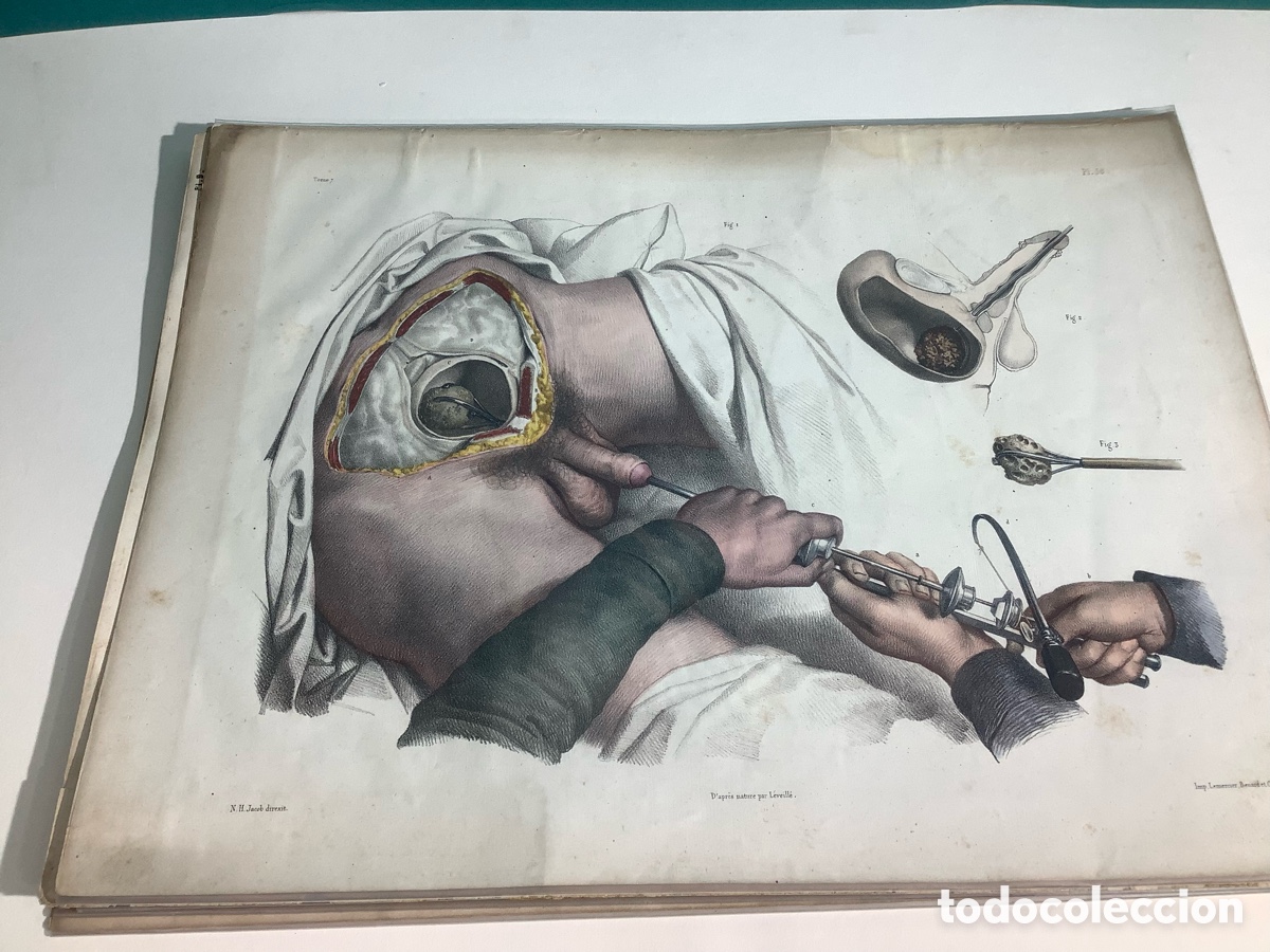 Arte: Litograf&iacute;a en color m&eacute;dica urolog&iacute;a siglo XIX Jean B. Bourgery