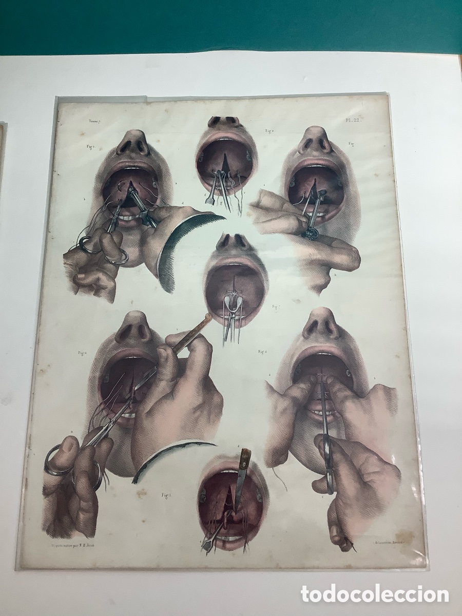 Arte: Litograf&iacute;a en color medica de J.B. Bourgery