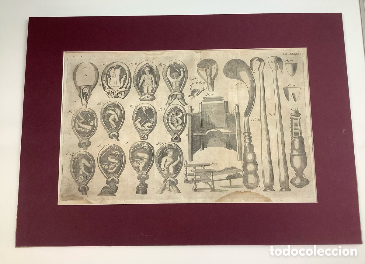 Arte: Lorenz Heister, grabado original 1750. Ginecolog&iacute;a