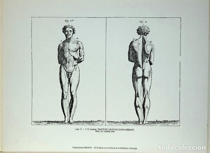 Kunst: T.H.Laennec.TRAITE DE L'AUSCULTATION MEDIATE.PATOLOGIA ,EL GRABADO EN LA HISTORIA DE LA MEDICINA.