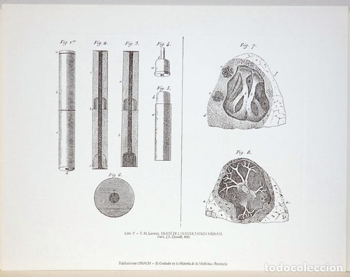 Art: T.H.Laennec.TRAITE DE L'AUSCULTATION MEDIATE.PATOLOGIA ,EL GRABADO EN LA HISTORIA DE LA MEDICINA.