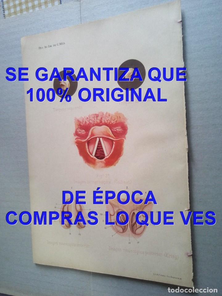 Arte: LITOGRAFIA FORUNY 1925 OTORRINOLARINGOLOGIA LAMINA 23 CM F05