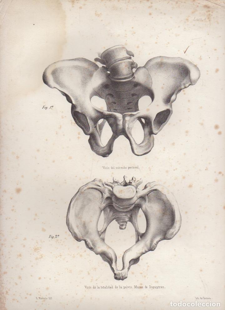 Art: LITOGRAFIA DE MEDICINA. VICIO DE LA TOTALIDAD DE LA PELVIS. LAMINA 4&ordf;. LIT. DE DONON G-MEDICA-002