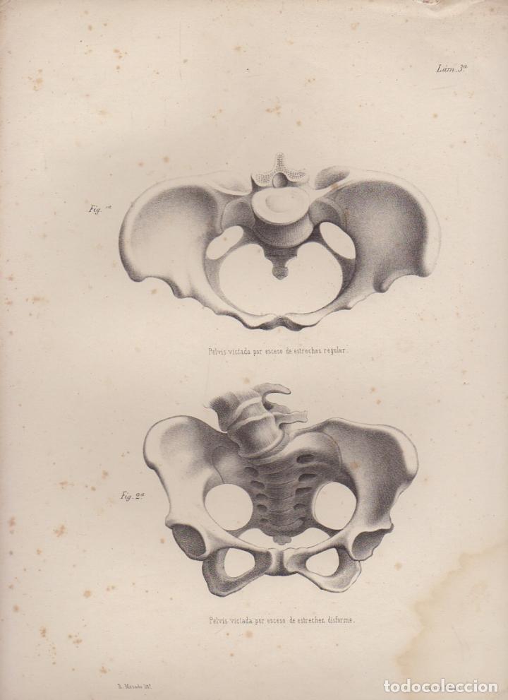 Art: LITOGRAFIA DE MEDICINA. PELVIS VICIADA POR EXCESO DE ESTRECHEZ. LAM. 3&ordf;. LIT. DE DONON G-MEDICA-003