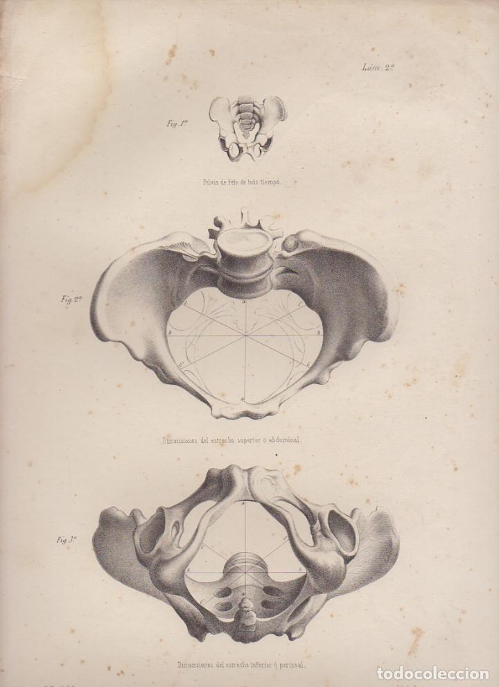 Art: LITOGRAFIA DE MEDICINA. DIMENSIONES DEL ESTRECHO INFERIOR. LAMINA 2&ordf;. LIT. DE DONON G-MEDICA-005