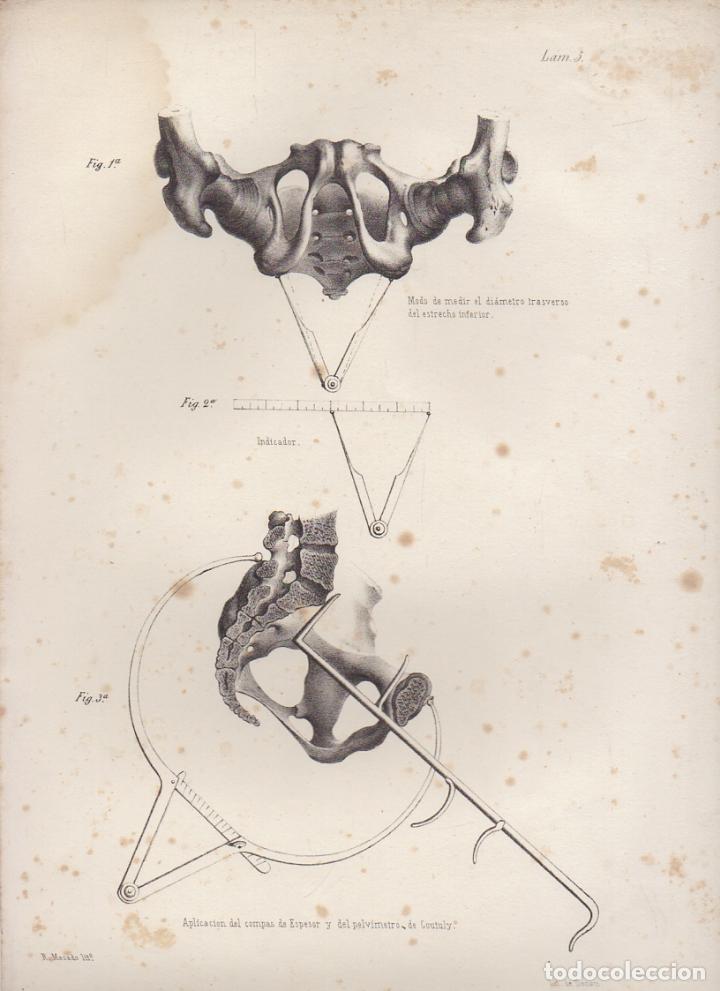 Art: LITOGRAFIA DE MEDICINA. APLICACI&Oacute;N DEL COMPAS DE ESPESOR. LAMINA 5&ordf;. LIT. DE DONON G-MEDICA-006