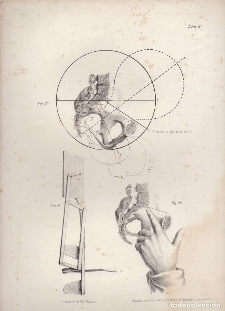 Art: LITOGRAFIA DE MEDICINA. PELVIMETRO DE MR. MARTIN. LAMINA 6&ordf;. LIT. DE DONON G-MEDICA-007
