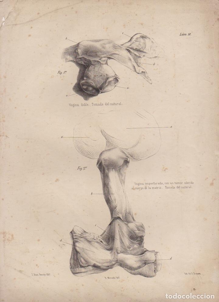 Art: LITOGRAFIA DE MEDICINA. VAGINA DOBLE. TOMADA DEL NATURAL. LAMINA 10&ordf;. LIT. DE DONON G-MEDICA-011