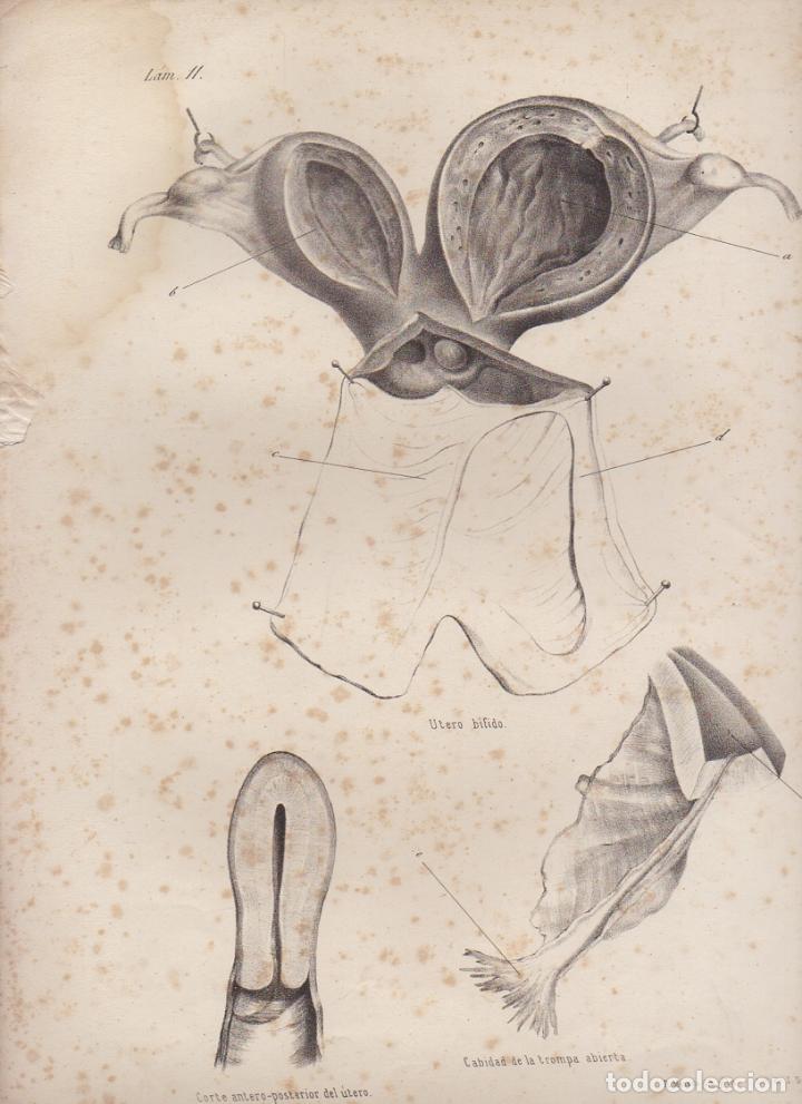 Art: LITOGRAFIA DE MEDICINA. UTERO BIFIDO. LAMINA 11&ordf;. LIT. DE DONON G-MEDICA-012