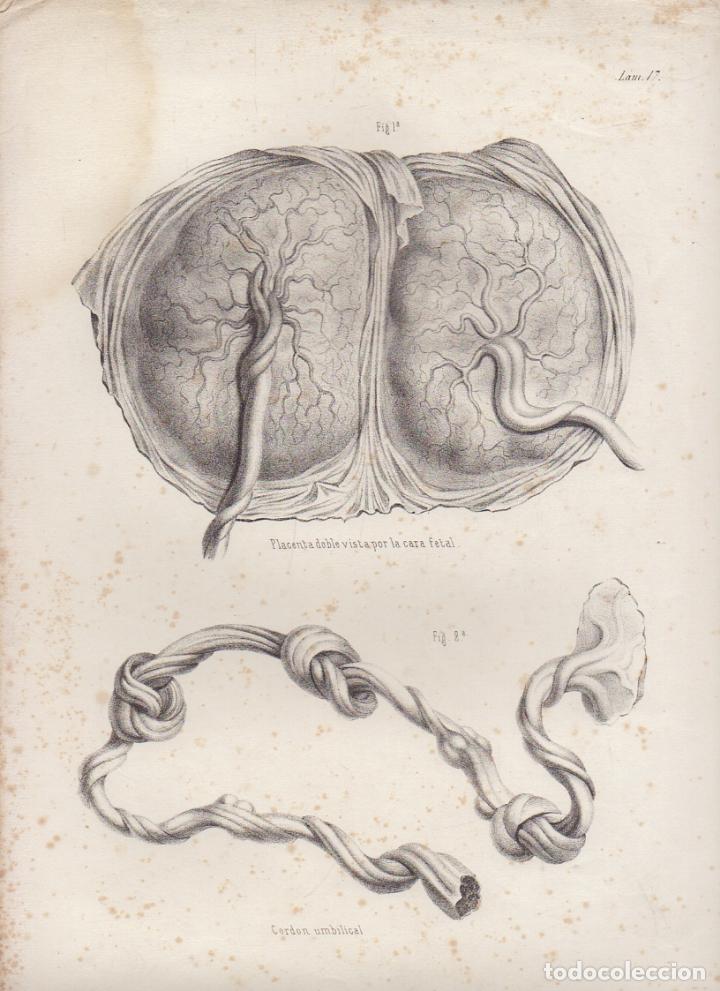 Art: LITOGRAFIA DE MEDICINA. PLACENTA DOBLE. LAMINA 17&ordf;. LIT. DE DONON G-MEDICA-014