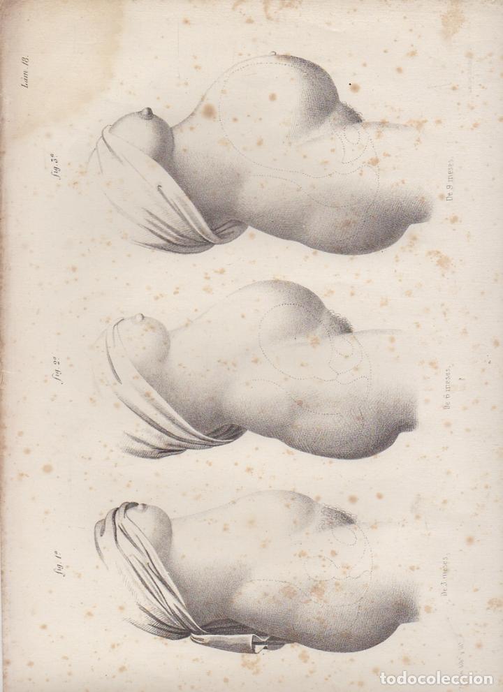 Art: LITOGRAFIA DE MEDICINA. EMBARAZO A LOS 3, 6 Y 9 MESES. LAMINA 18&ordf;. LIT. DE DONON G-MEDICA-015