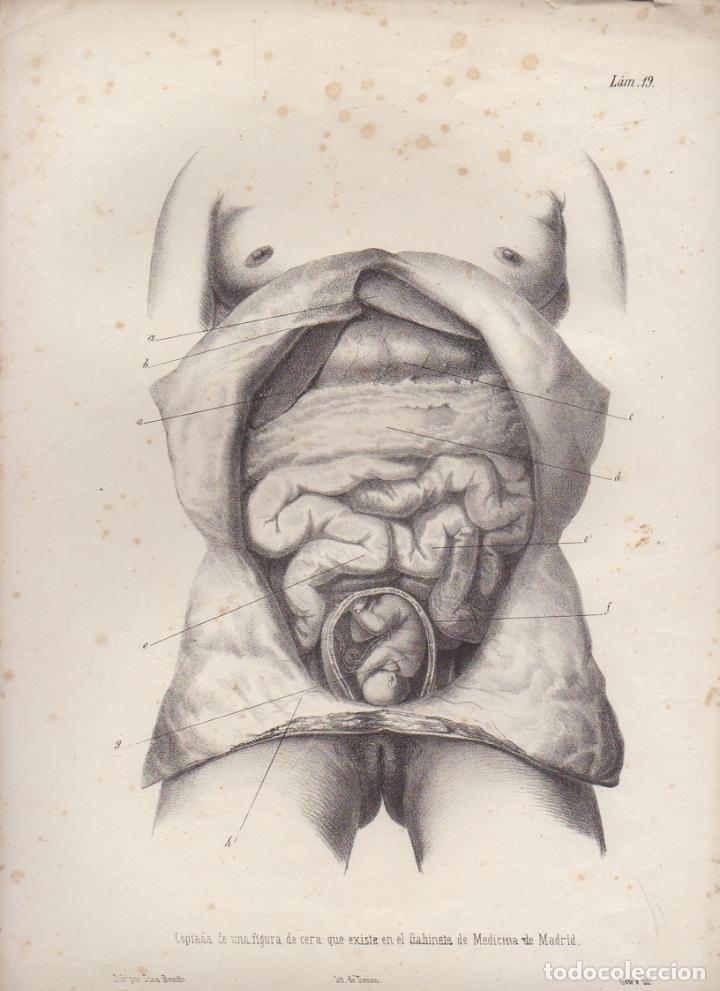 Art: LITOGRAFIA DE MEDICINA. EMBARAZO. COPIADA DE UNA FIGURA DE CERA. G-MEDICA-016
