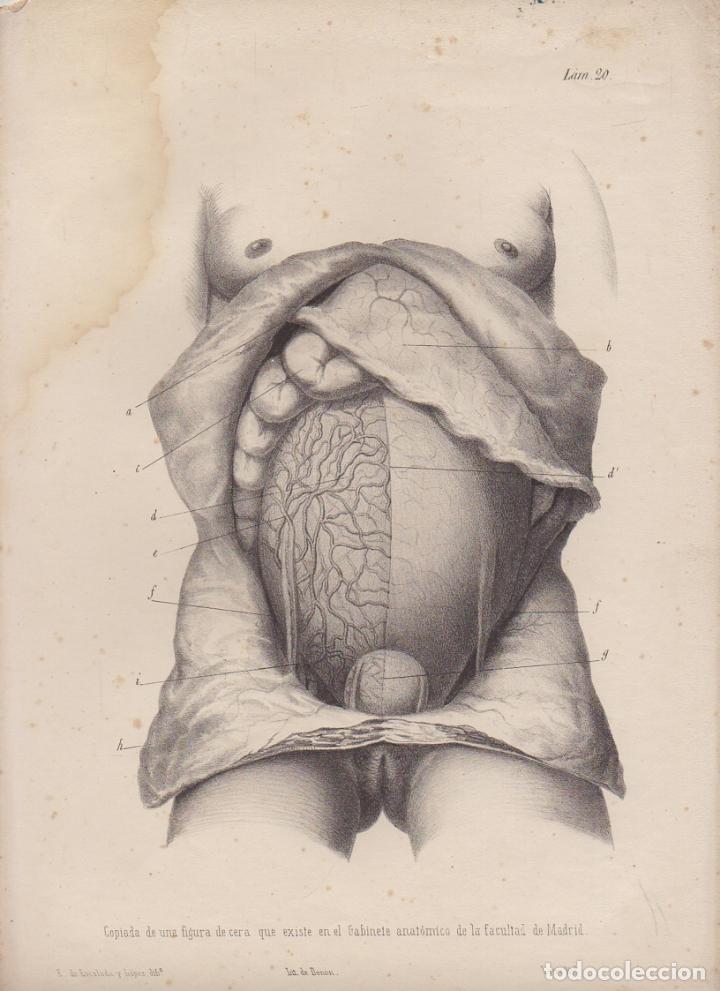 Art: LITOGRAFIA DE MEDICINA. EMBARAZO. COPIADA DE FIGURA DE CERA. LAMINA 20&ordf;. LIT. DE DONON G-MEDICA-017