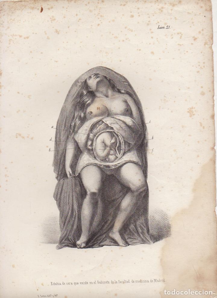 Art: LITOGRAFIA DE MEDICINA. ESTATUA DE CERA DE LA UNIVERSIDAD. LAM. 21&ordf;. LIT. DE DONON G-MEDICA-018