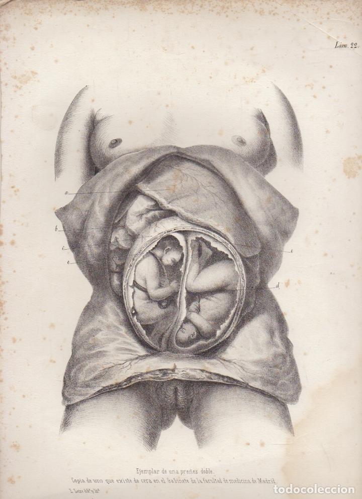 Art: LITOGRAFIA DE MEDICINA. EJEMPLAR DE UNA PRE&Ntilde;EZ DOBLE. LAMINA 22&ordf;. LIT. DE DONON G-MEDICA-019