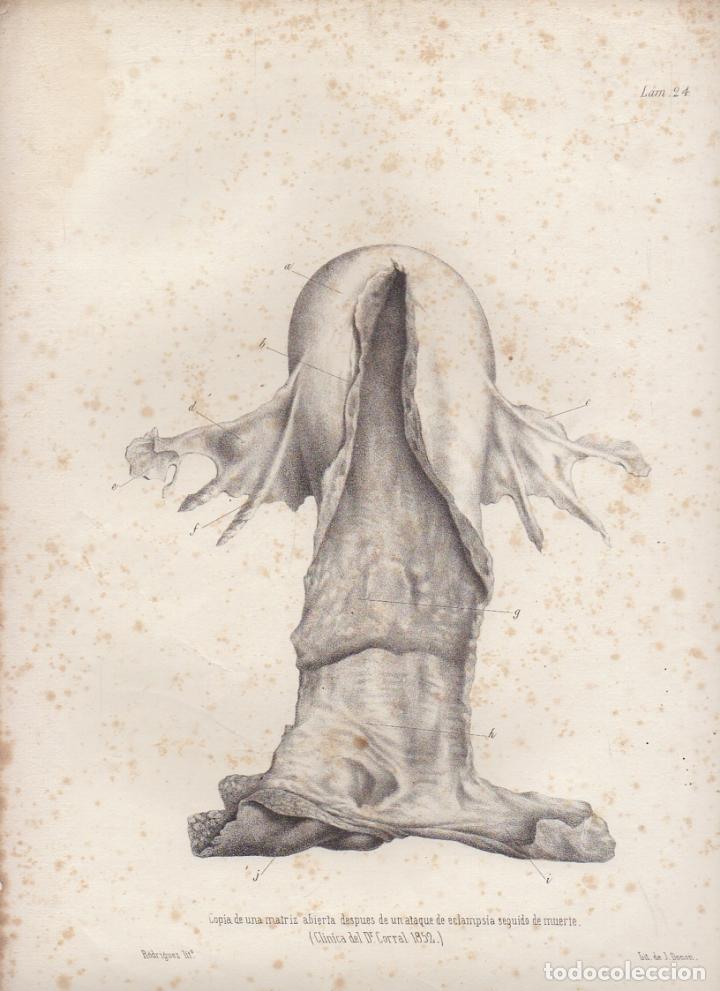 Art: LITOGRAFIA DE MEDICINA. COPIA DE UNA MATRIZ ABIERTA. LAMINA 24&ordf;. LIT. DE DONON G-MEDICA-020