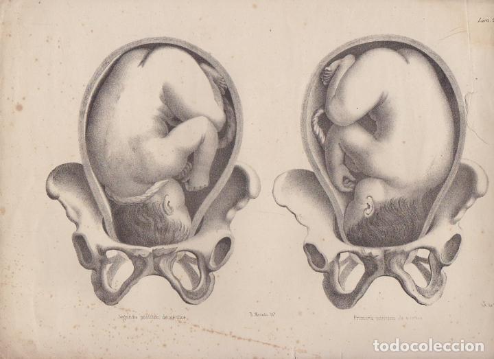 Arte: LITOGRAFIA DE MEDICINA. PRIMERA Y SEGUNDA POSICION DE VERTICE. LAM. 28&ordf;. LIT. DE DONON G-MEDICA-022