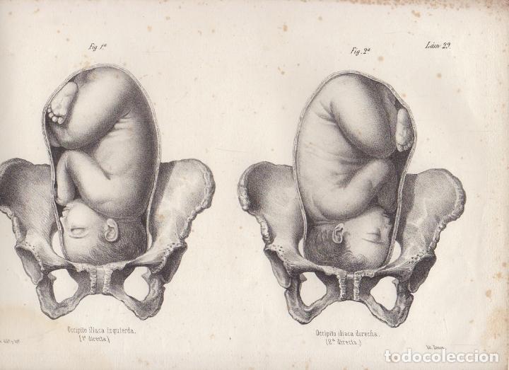 Arte: LITOGRAFIA DE MEDICINA. OCCIPITO ILIACA IZQUIERDA Y DERECHA. LAM. 29&ordf;. LIT. DE DONON G-MEDICA-023