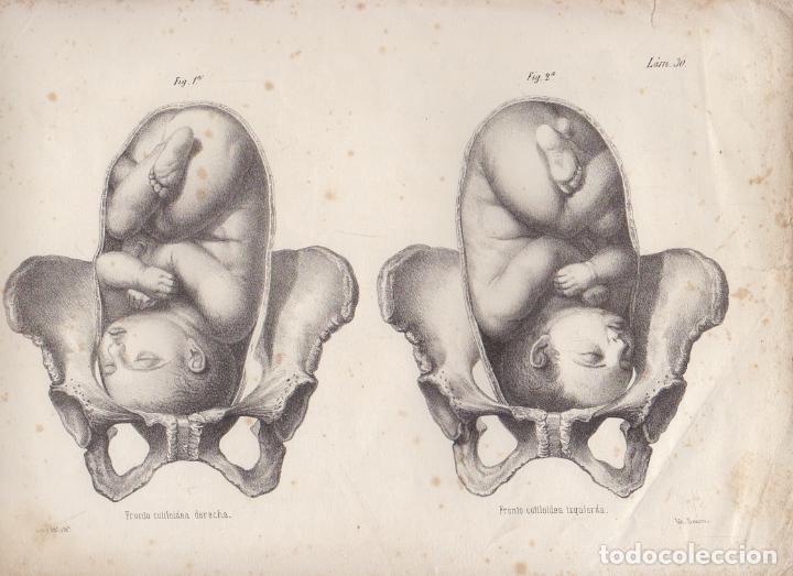 Arte: LITOGRAFIA DE MEDICINA. FRONTO COTILOIDEA IZQUIERDA Y DERECHA. LAM. 30&ordf;. LIT. DE DONON G-MEDICA-024
