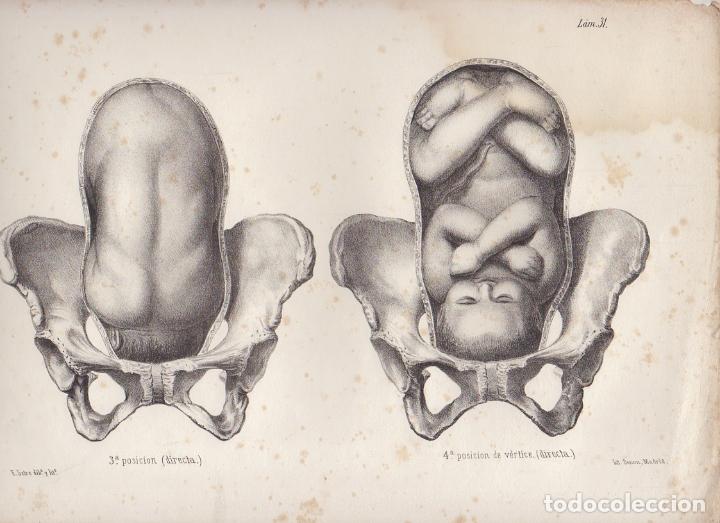 Arte: LITOGRAFIA DE MEDICINA. TERCERA Y CUARTA POSICION DE VERTICE. LAM. 31&ordf;. LIT. DE DONON G-MEDICA-025