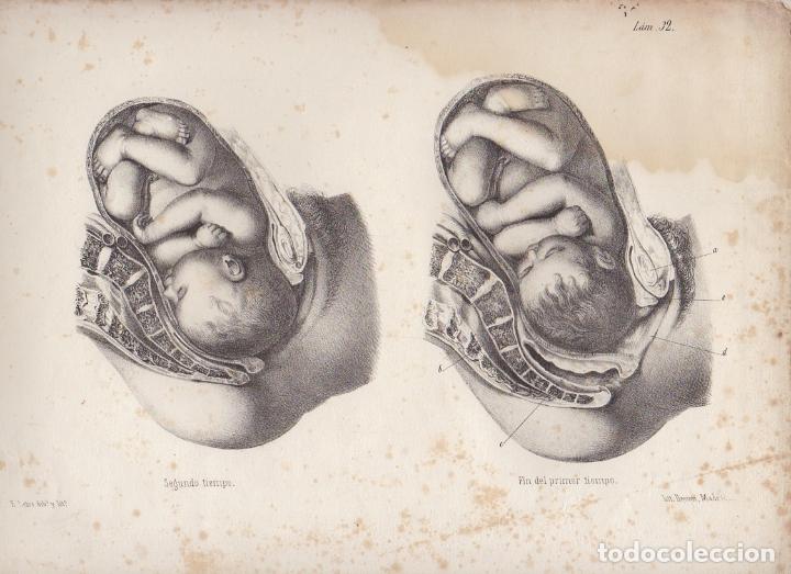 Arte: LITOGRAFIA DE MEDICINA. SEGUNDO TIEMPO Y FIN DEL PRIMER TIEMPO. LAM 32&ordf;. LIT. DE DONON G-MEDICA-026
