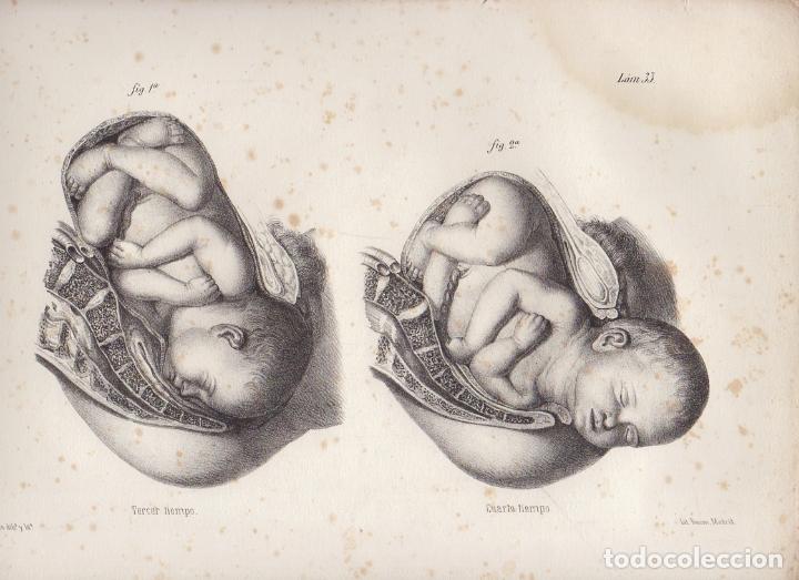 Art: LITOGRAFIA DE MEDICINA. TERCER Y CUARTO TIEMPO. LAMINA 33&ordf;. LIT. DE DONON G-MEDICA-027