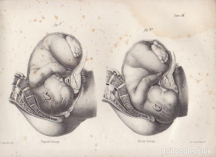 Art: LITOGRAFIA DE MEDICINA. SEGUNDO Y TERCER TIEMPO. LAMINA 34&ordf;. LIT. DE DONON G-MEDICA-028