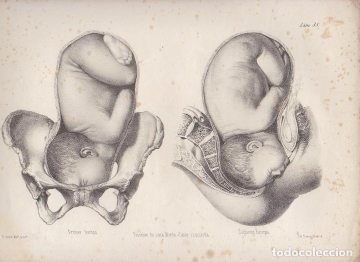 Art: LITOGRAFIA DE MEDICINA. POSICION DE CARA. MENTO-ILIACA. LAMINA 35&ordf;. LIT. DE DONON G-MEDICA-029