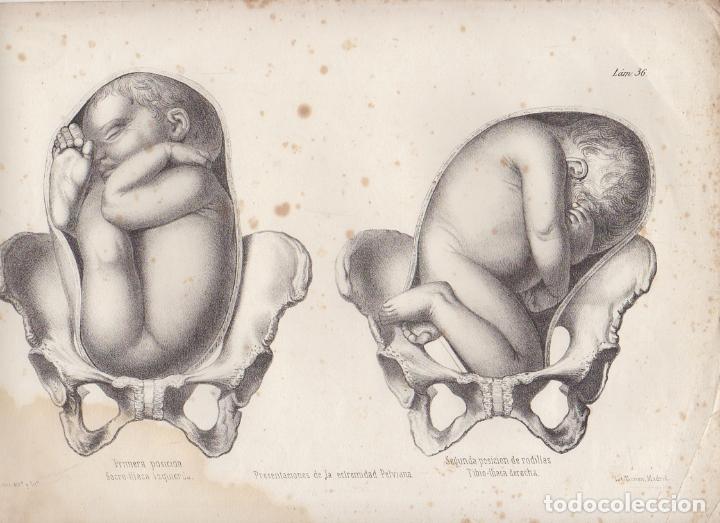 Art: LITOGRAFIA DE MEDICINA. PRESENTACIONES ESTREMIDAD PELVIANA. LAMINA 36&ordf;. LIT. DE DONON G-MEDICA-030