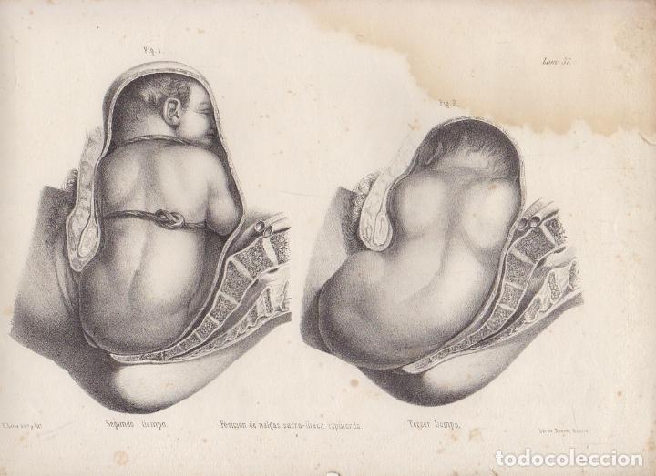 Art: LITOGRAFIA DE MEDICINA. POSICION DE NALGAS SACRO-ILIACA. LAMINA 37&ordf;. LIT. DE DONON G-MEDICA-031