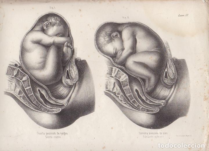 Art: LITOGRAFIA DE MEDICINA. 4&ordf; POSICION DE NALGAS Y 3&ordf; DE PIES. LAMINA 38&ordf;. LIT. DE DONON G-MEDICA-032