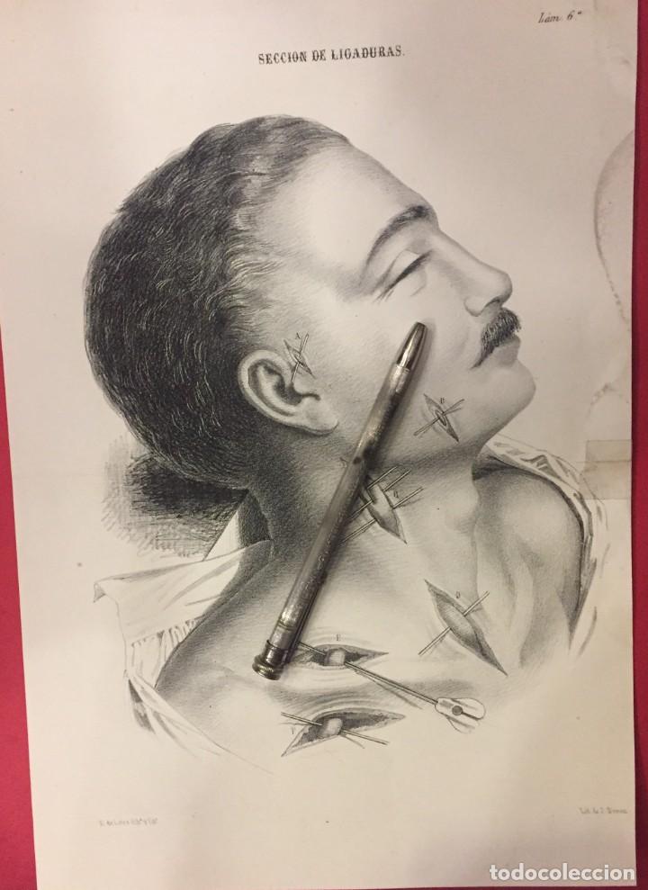 Arte: LITOGRAFIA MEDICA DEL SIGLO XIX, E. DE LETRE DIBUJO Y J. DONON LITOGRAFIO. LIGADURAS