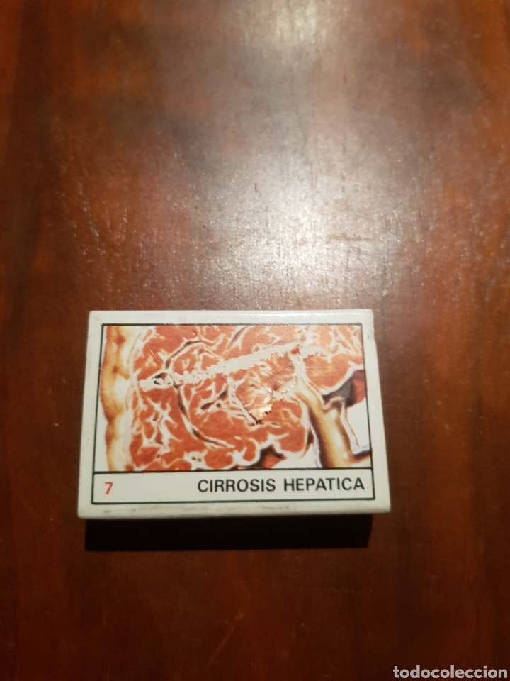 Cajas de cerillas: Caja de cerillas cirrosis hep&aacute;tica - Foto 1